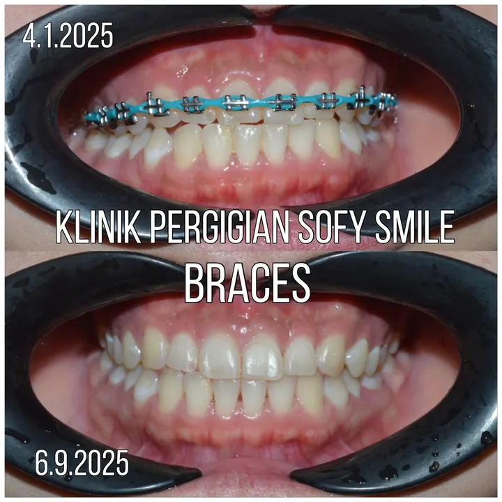 Sebelum dan selepas rawatan braces, kes pesakit Sofy Smile