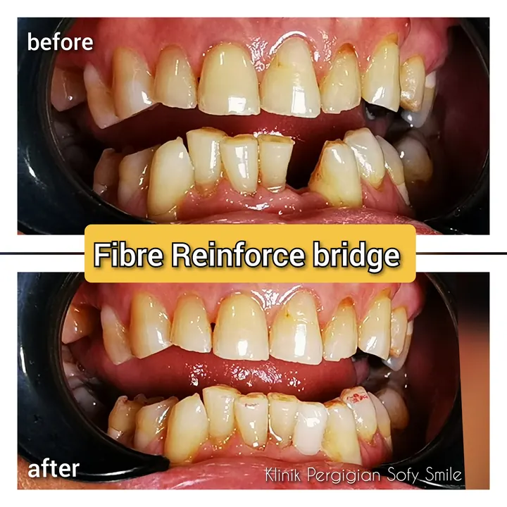 Sebelum dan selepas Fibre Reinforced Bridge, kes pesakit Sofy Smile
