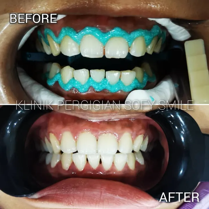 Sebelum dan selepas pemutihan gigi, kes pesakit Sofy Smile